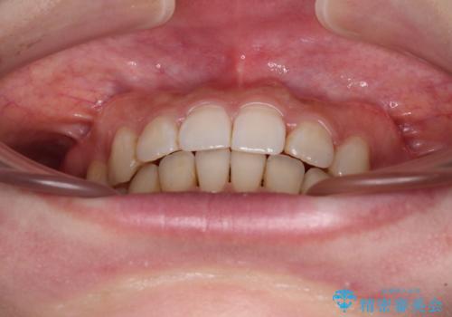 ディープバイトとデコボコを解消 インビザライン矯正の治療後