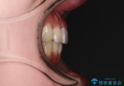 ディープバイトとデコボコを解消 インビザライン矯正の治療後