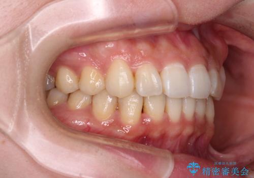 ディープバイトとデコボコを解消 インビザライン矯正の治療後
