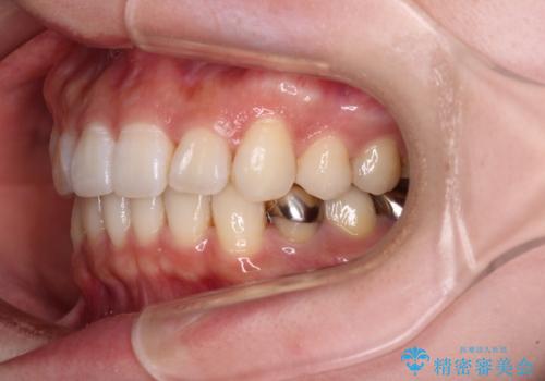 ディープバイトとデコボコを解消 インビザライン矯正の治療後