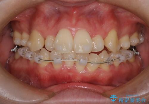 【難症例 インビザライン】抜歯+遠心移動ケースの治療中