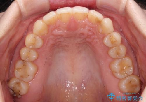 ディープバイトとデコボコを解消 インビザライン矯正の治療後