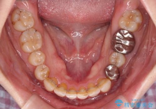 ディープバイトとデコボコを解消 インビザライン矯正の治療後