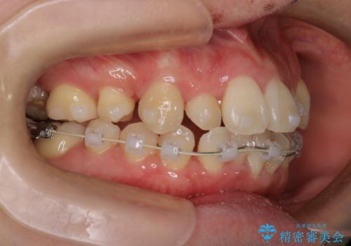 【難症例 インビザライン】抜歯+遠心移動ケースの治療中