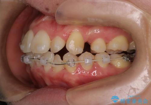 【難症例 インビザライン】抜歯+遠心移動ケースの治療中