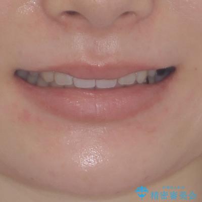 ディープバイトとデコボコを解消 インビザライン矯正の治療後(顔貌)