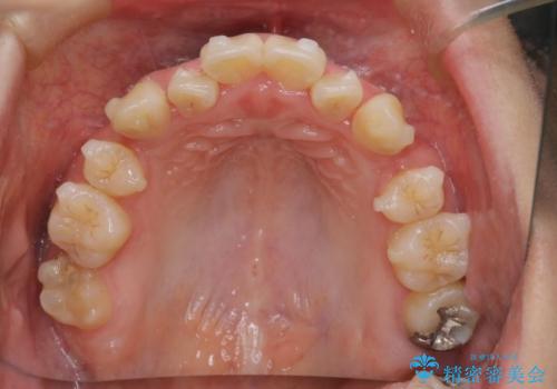【難症例 インビザライン】抜歯+遠心移動ケースの治療中