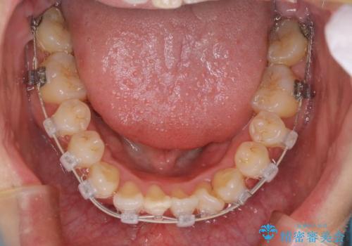【難症例 インビザライン】抜歯+遠心移動ケースの治療中