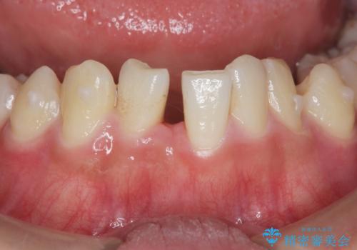 [ 下顎3前歯の矯正治療 ]  3インサイザー仕上げのマウスピース矯正の治療中