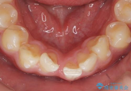 [ 下顎3前歯の矯正治療 ]  3インサイザー仕上げのマウスピース矯正の治療中