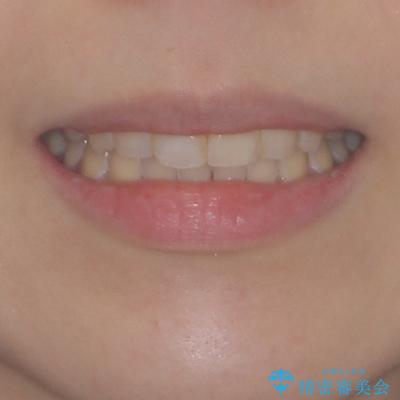 上下前歯の前歯と腫れやすい歯肉　インビザライン矯正で改善の治療後（顔貌）