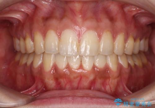 上下前歯の前歯と腫れやすい歯肉　インビザライン矯正で改善の症例 治療後