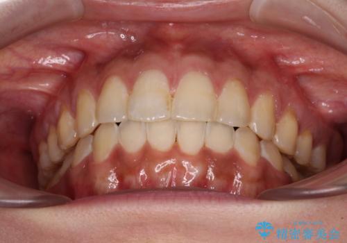 上下前歯の前歯と腫れやすい歯肉　インビザライン矯正で改善の治療後
