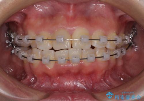 虫歯と抜いたままの奥歯とデコボコの前歯 総合歯科治療の治療中