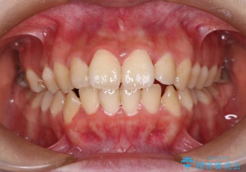 【ハーフリンガル】口元を下げたい!の治療前