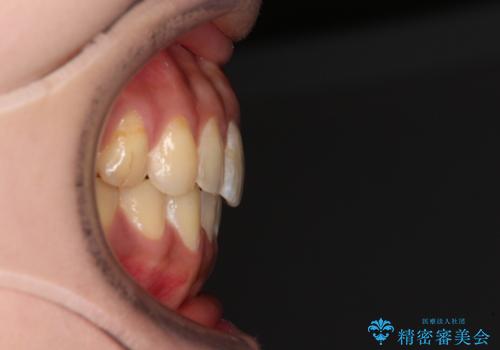 上下前歯の前歯と腫れやすい歯肉 インビザライン矯正で改善の治療後