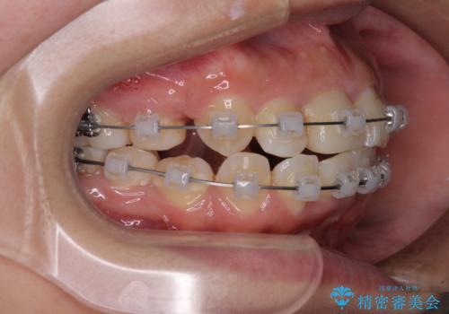 虫歯と抜いたままの奥歯とデコボコの前歯　総合歯科治療の治療中
