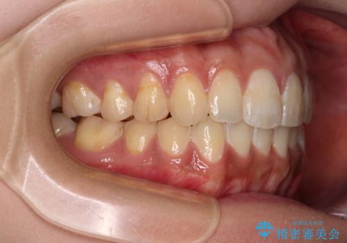 上下前歯の前歯と腫れやすい歯肉 インビザライン矯正で改善の治療後