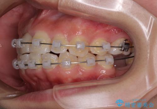 虫歯と抜いたままの奥歯とデコボコの前歯 総合歯科治療の治療中