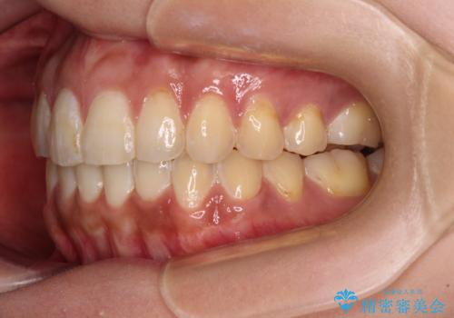 上下前歯の前歯と腫れやすい歯肉　インビザライン矯正で改善の治療後