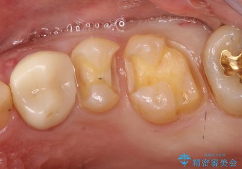 【保険治療したところが再び虫歯に】セラミックインレーで治療の治療中