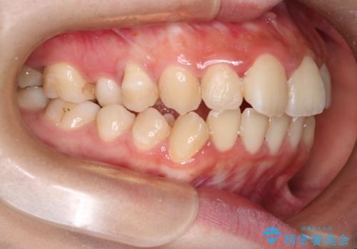 【ハーフリンガル】口元を下げたい!の治療前