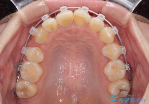 虫歯と抜いたままの奥歯とデコボコの前歯　総合歯科治療の治療中