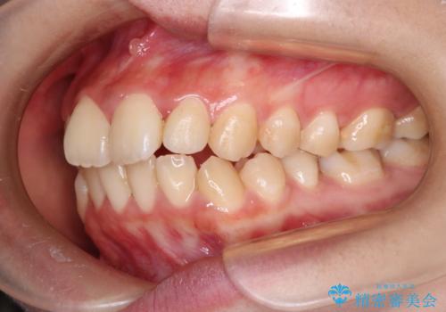 【ハーフリンガル】口元を下げたい!の治療前