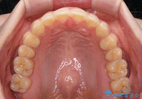 上下前歯の前歯と腫れやすい歯肉 インビザライン矯正で改善の治療後
