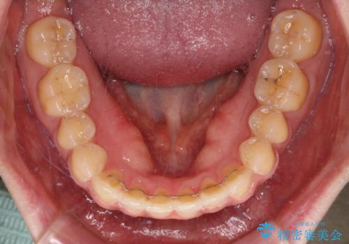 上下前歯の前歯と腫れやすい歯肉 インビザライン矯正で改善の治療後