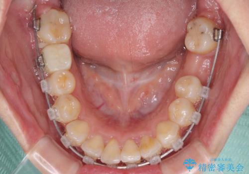 虫歯と抜いたままの奥歯とデコボコの前歯 総合歯科治療の治療中