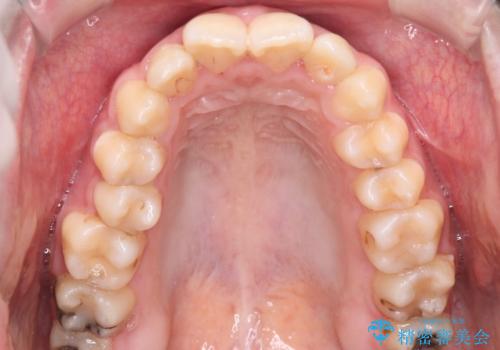 【ハーフリンガル】口元を下げたい!の治療前