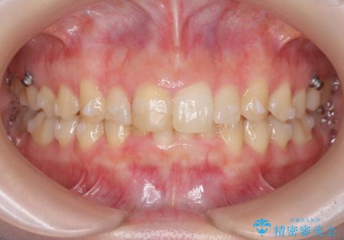 前歯のがたつき 深い噛み合わせを改善したいの治療中