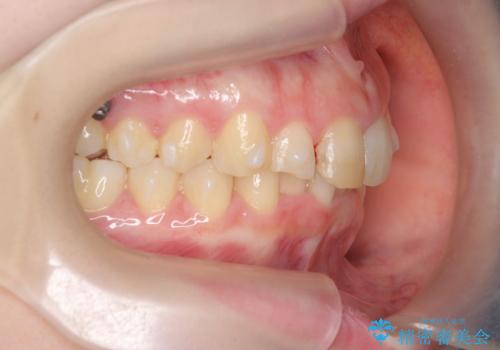 前歯のがたつき　深い噛み合わせを改善したいの治療中