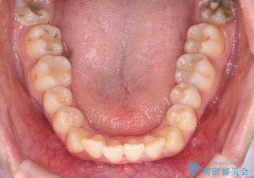 【ハーフリンガル】口元を下げたい!の治療前