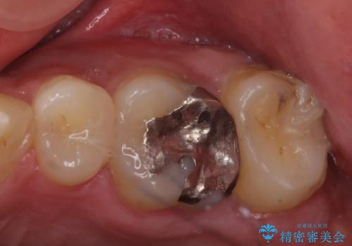 奥歯のザラザラが気になるの症例 治療前
