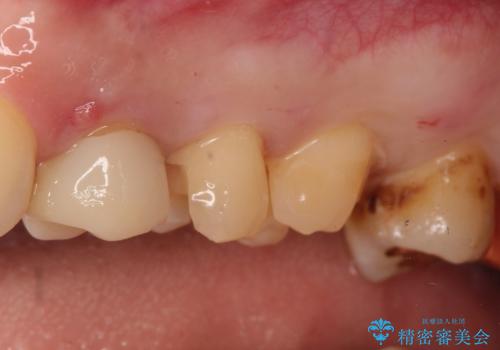 【保険治療したところが再び虫歯に】セラミックインレーで治療の治療中