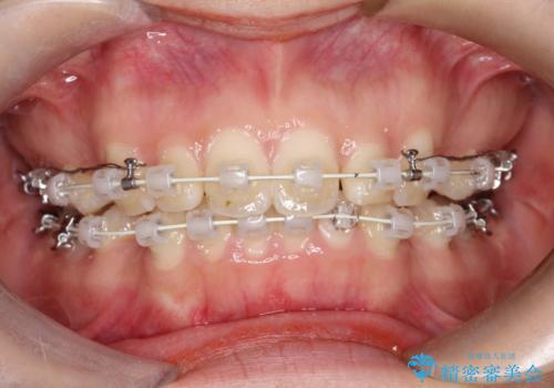 口元を下げてすっきりさせたい ワイヤー抜歯矯正で口元の改善の治療中