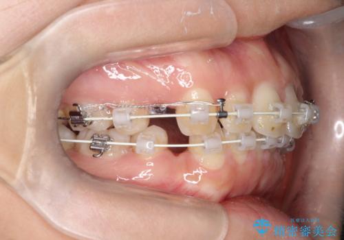 口元を下げてすっきりさせたい　ワイヤー抜歯矯正で口元の改善の治療中