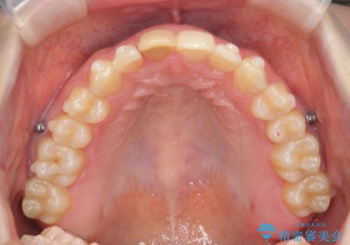 前歯のがたつき 深い噛み合わせを改善したいの治療中