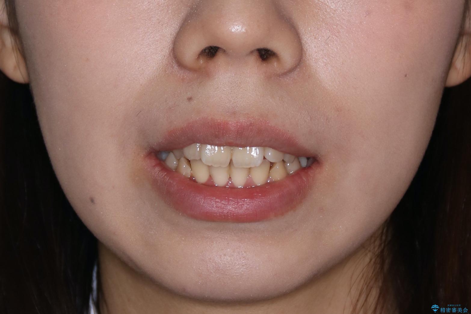 【ハーフリンガル】口元を下げたい!の治療前(顔貌)