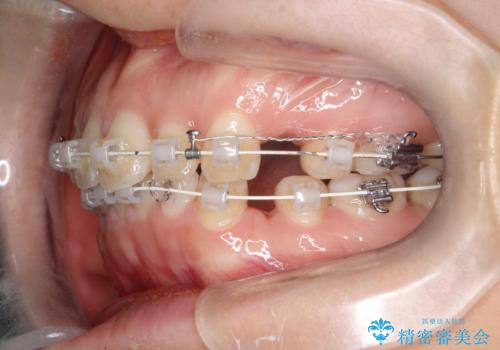 口元を下げてすっきりさせたい ワイヤー抜歯矯正で口元の改善の治療中