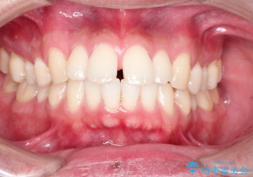 前歯の隙間を閉じたい　口元も下げたい　ハーフリンガルによる抜歯矯正の症例 治療前