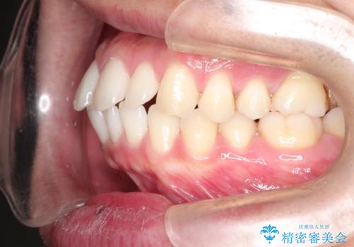 前歯の隙間を閉じたい　口元も下げたい　ハーフリンガルによる抜歯矯正の治療前