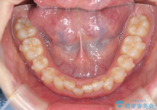 前歯のがたつき 深い噛み合わせを改善したいの治療中