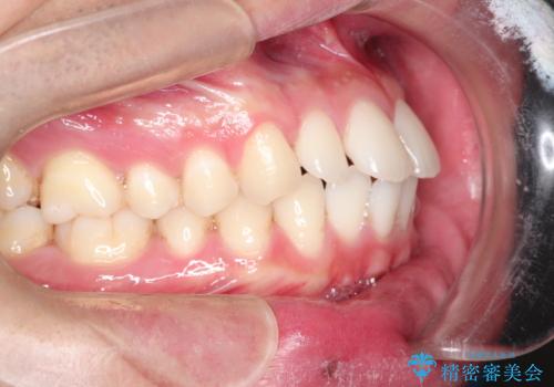 前歯の隙間を閉じたい 口元も下げたい ハーフリンガルによる抜歯矯正の治療前