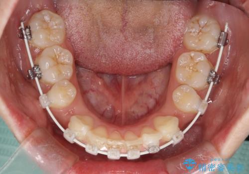 口元を下げてすっきりさせたい ワイヤー抜歯矯正で口元の改善の治療中
