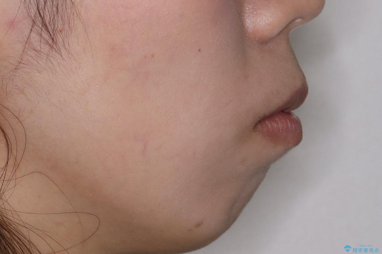 【ハーフリンガル】口元を下げたい!の治療前(顔貌)