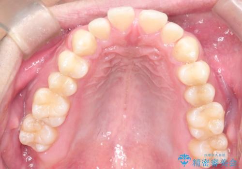 前歯の隙間を閉じたい 口元も下げたい ハーフリンガルによる抜歯矯正の治療前