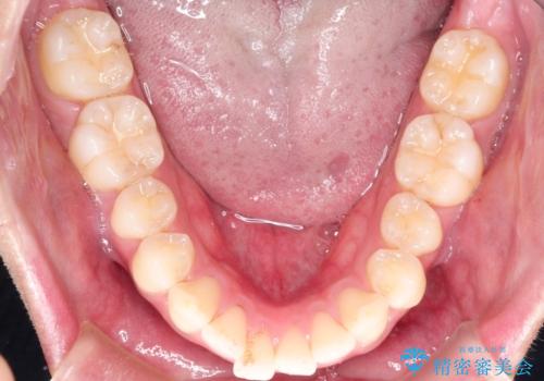 前歯の隙間を閉じたい 口元も下げたい ハーフリンガルによる抜歯矯正の治療前